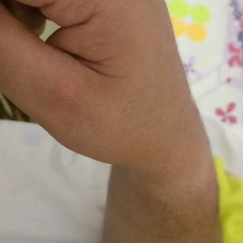 Dyson V8 Süpürge Kullanımında Yanık Ve Güvenlik Sorunu