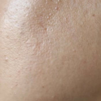 Cosmed Ürünleri Cildimi Mahvetti, Yüzümde Leke ve Gözenek Oluştu