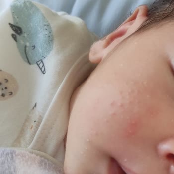 Mustela Yenidoğan Şampuanı Bebeğimin Cildinde Kızarıklık Ve Sivilceye Sebep Oldu