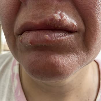 Bioderma Leke Karşıtı Güneş Kremi Yüzümde Kızarıklık Ve Şişkinlik Yaptı