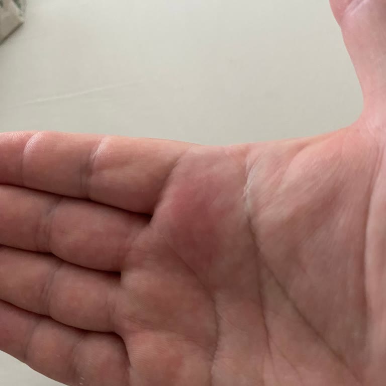 Maden Suyu Şişesinin Kapağı Patladı, Güvenlik Riski Yaşadım