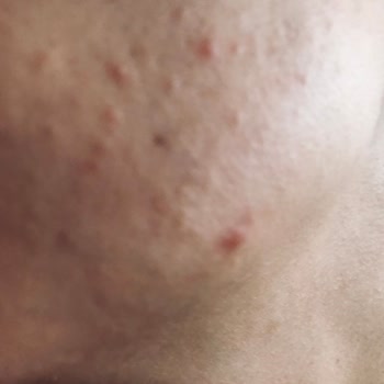 Sivilce Önleyici Yüz Temizleyicisi Cildimi Mahvetti