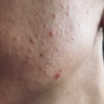 Sivilce Önleyici Yüz Temizleyicisi Cildimi Mahvetti