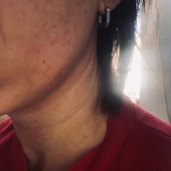 Sivilce Önleyici Yüz Temizleyicisi Cildimi Mahvetti