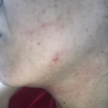 Sivilce Önleyici Yüz Temizleyicisi Cildimi Mahvetti