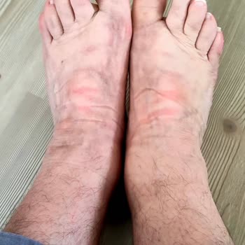 Skechers Ayakkabı Ayağımda Morarma Yaptı, İade Süreci Mağduriyeti