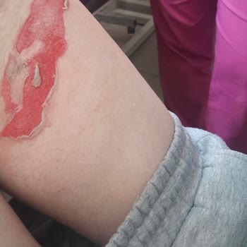 Otobüste Dökülen Sıcak Kahveyle Yandım Muavin Yardım Etmedi Kalıcı İz Kaldı