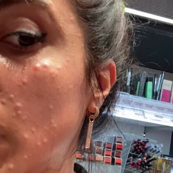 Aldığım Güneş Kremi Cildimde Yanık Ve Sivilce Oluşturdu, Tedavi Masraflarım Karşılanmıyor