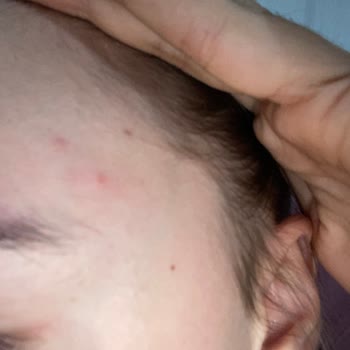 Watsons Frudia Mangolu Maske Sonrası Ciltte Sivilce Problemi