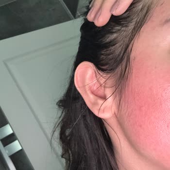 Dermokil Kil Maskesi Sonrası Yüzümde Şişlik Ve Yanma Yaşadım