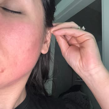 Dermokil Kil Maskesi Sonrası Yüzümde Şişlik Ve Yanma Yaşadım