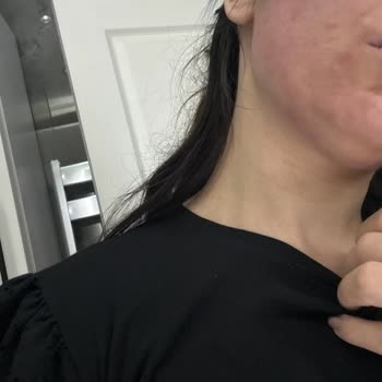 Dermokil Kil Maskesi Sonrası Yüzümde Şişlik Ve Yanma Yaşadım