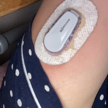 I Got Painful Skin Reactions from Dexcom G6 Sensors After G7 Was Released