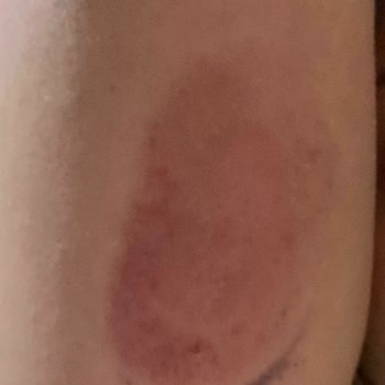 I Got Painful Skin Reactions from Dexcom G6 Sensors After G7 Was Released