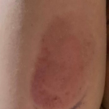 I Got Painful Skin Reactions from Dexcom G6 Sensors After G7 Was Released