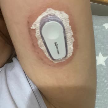 I Got Painful Skin Reactions from Dexcom G6 Sensors After G7 Was Released