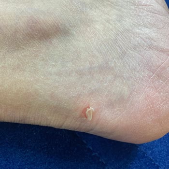 Calvin Klein Ayakkabı Her Giyişte Ayağımı Yaraladı