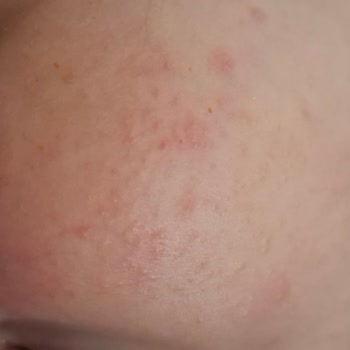 Mustela Güneş Kremi Bebeğimde Ciddi Yan Etki Yaptı