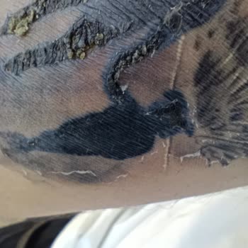 Dövme Sonrası Enfeksiyon Ve Merkezin İlgisizliği Mağduriyetimi Artırdı