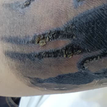 Dövme Sonrası Enfeksiyon Ve Merkezin İlgisizliği Mağduriyetimi Artırdı