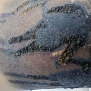 Dövme Sonrası Enfeksiyon Ve Merkezin İlgisizliği Mağduriyetimi Artırdı