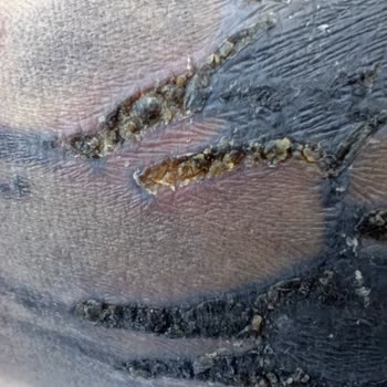 Dövme Sonrası Enfeksiyon Ve Merkezin İlgisizliği Mağduriyetimi Artırdı