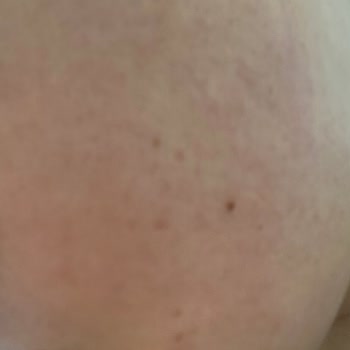 Eyüp Sabri Tuncer Gülsuyu Yüzümde Tahrişe Ve Kızarıklığa Sebep Oldu