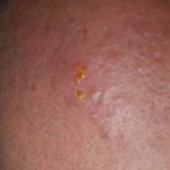 Lazer Uygulaması Sonrası Yanık Ve Mağduriyet