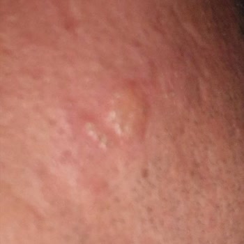 Lazer Uygulaması Sonrası Yanık Ve Mağduriyet