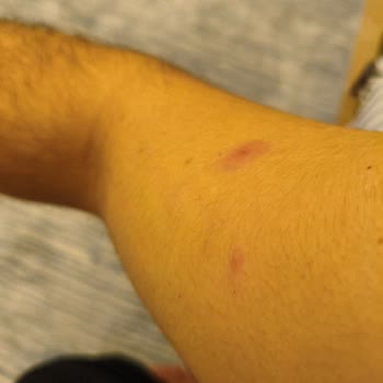 I Had a Severe Reaction After Using Möller’s Omega-3 Capsules I Just Bought