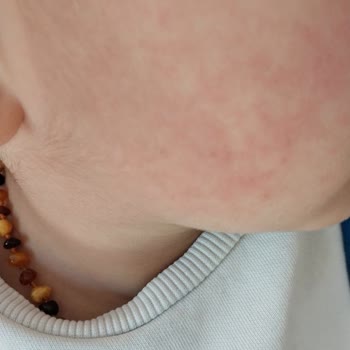 My Child’s Skin Turns Red Without Daily Use of Möller’s Fish Oil