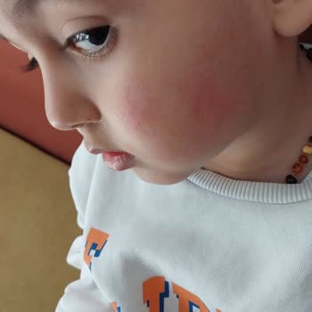 My Child’s Skin Turns Red Without Daily Use of Möller’s Fish Oil