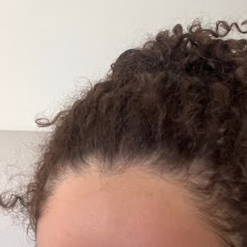 Claderm Kil Maskesi Cildimde Şiddetli Kızarıklık Ve Acıya Sebep Oldu