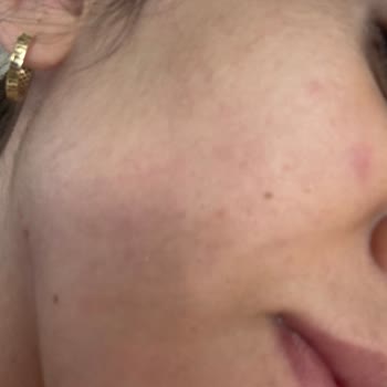 Bobbi Brown Baz Sonrası Büyük Sivilcelerle Mücadelem