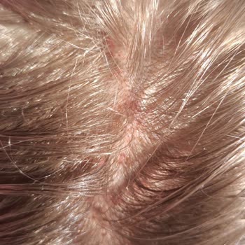 Yanlış Saç İşlemi Sonrası Mağduriyet Ve Telafi Eksikliği