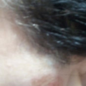 Lazer Epilasyon Sonrası Yüzümde İkinci Derece Yanık Oluştu