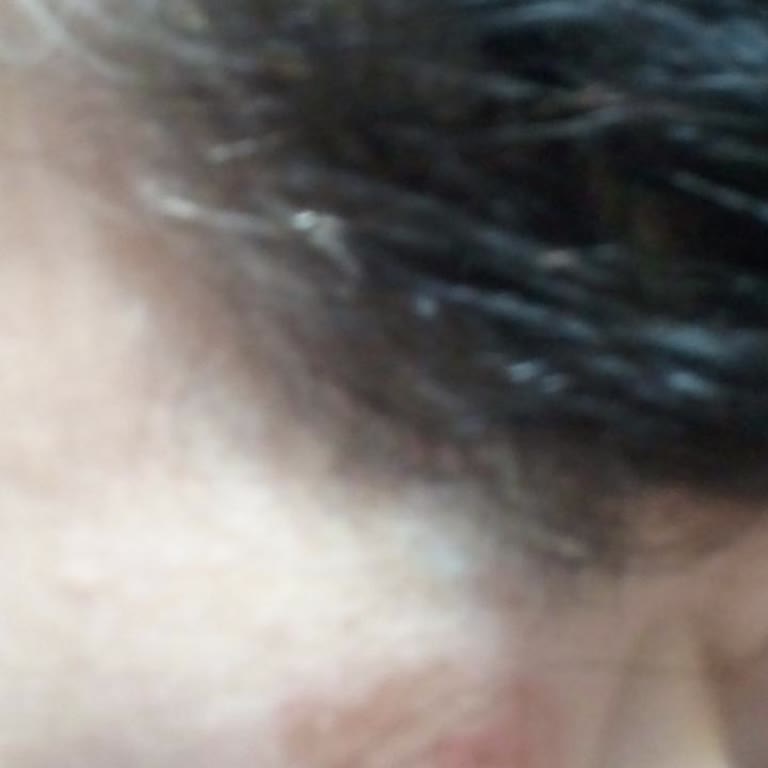 Lazer Epilasyon Sonrası Yüzümde İkinci Derece Yanık Oluştu