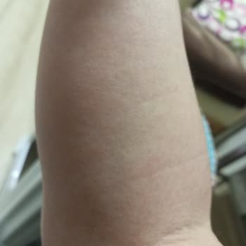 Humanis Sağlık İbucold C Kullandıktan Sonra Ciddi Alerjik Reaksiyon Yaşadım