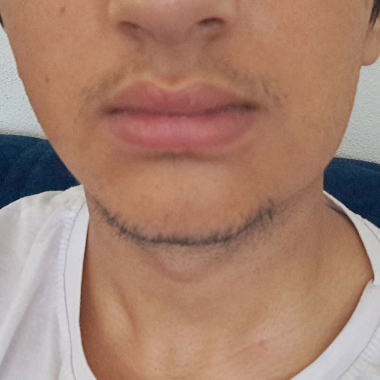 Croxilex Antibiyotik Sonrası Yüzüm Şişti Etkisiz İlaç Mağduriyeti