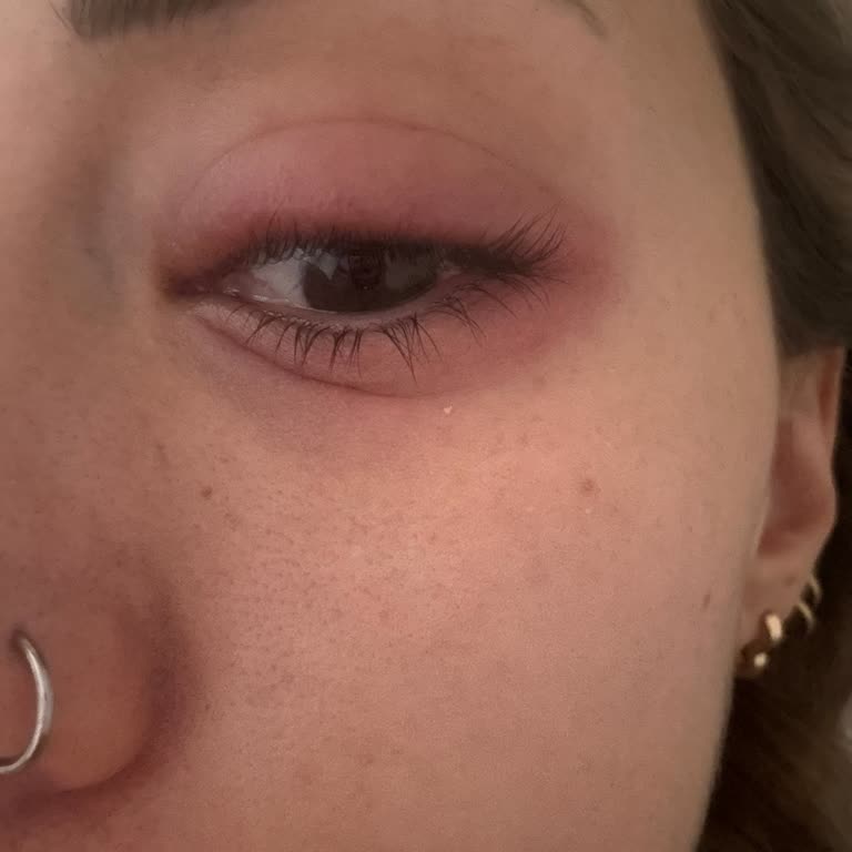 Kirpik Lifting Sonrası Gözlerimde Enfeksiyon Ve Şişlik Yaşadım