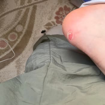 Puma Ayakkabı İlk Giyişte Deforme Oldu Ve Yaralar Oluştu