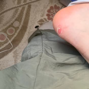 Aldığım Ayakkabı İlk Kullanımda Deforme Oldu Ve Ayağımı Yaraladı