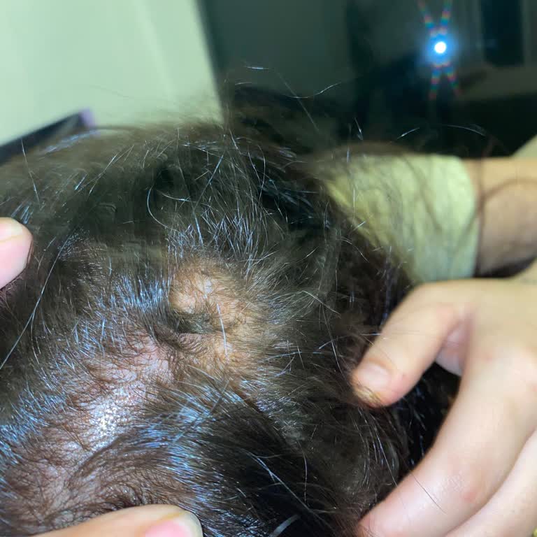 Saç İşleminde Yanlış Uygulama Sonucu Saç Derimde Yanık Ve Saç Dökülmesi