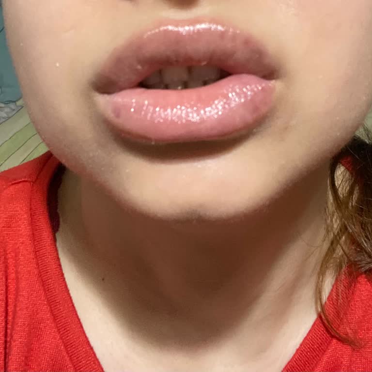 S&G Class Güzellik Salonu Dudak Dolgusu Yamuk Yapıldı