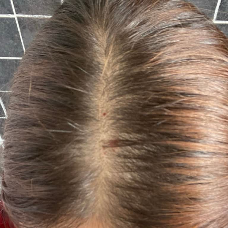 Vichy Dercos Şampuan Saçlarımı Kuruttu Ve Kaşıntıya Yol Açtı