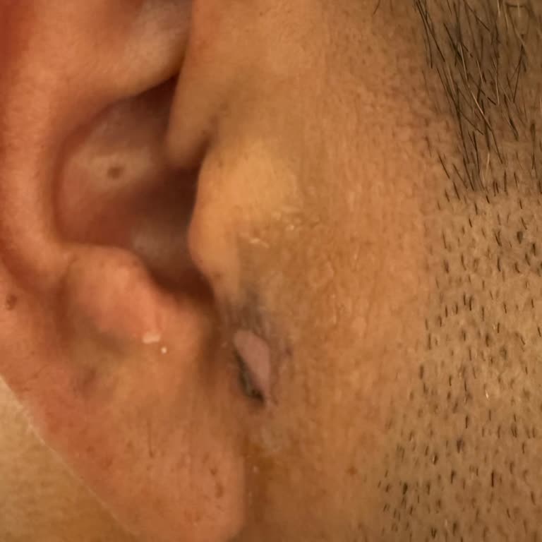 Lazer İşlemi Sonrası Ciltte Yanık Ve Leke Problemi