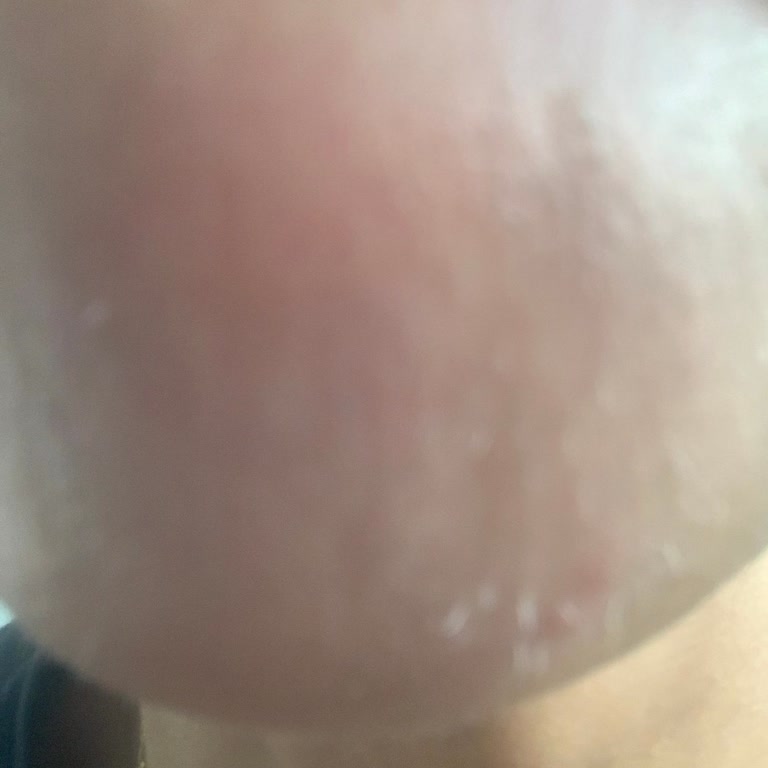 Lazer Epilasyon Aleti Beklentimi Karşılamadı, İade Süresi Doldu