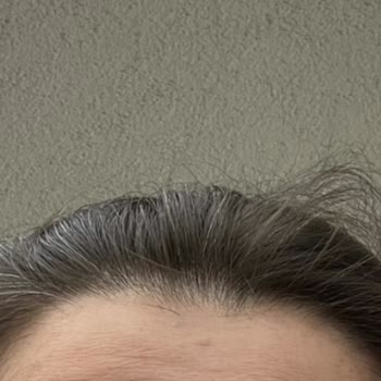 Botoks Uygulamasında Beklentilerin Karşılanmaması Ve Bilgilendirme Eksikliği