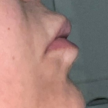 Yapılan Dudak Dolgusu Sonrası Yaşadığım Mağduriyet