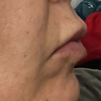 Yapılan Dudak Dolgusu Sonrası Yaşadığım Mağduriyet